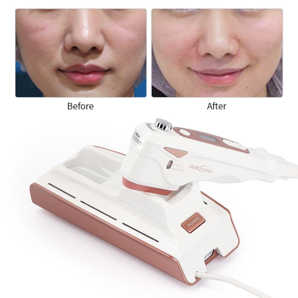 Appareil de Lifting Facial Ultrasonique Home V