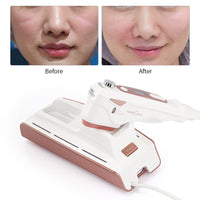 Appareil de Lifting Facial Ultrasonique Home V